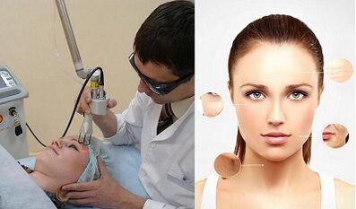 Како се врши ласерско подмлађивање коже